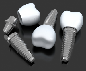 Dental Implants - 3 Step