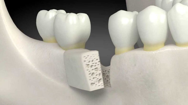 Bone grafting - Lower teeth