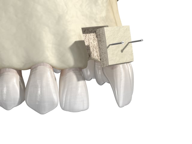 Bone grafting - upper teeth