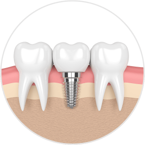 implant dentures image