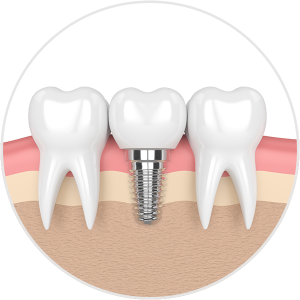 implant dentures image