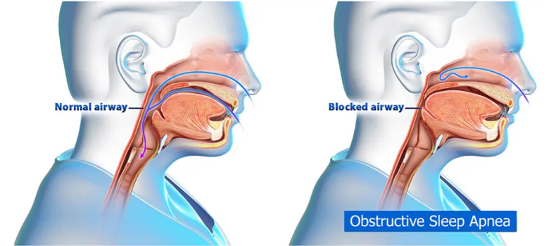 image showing the upper airway partially blocked