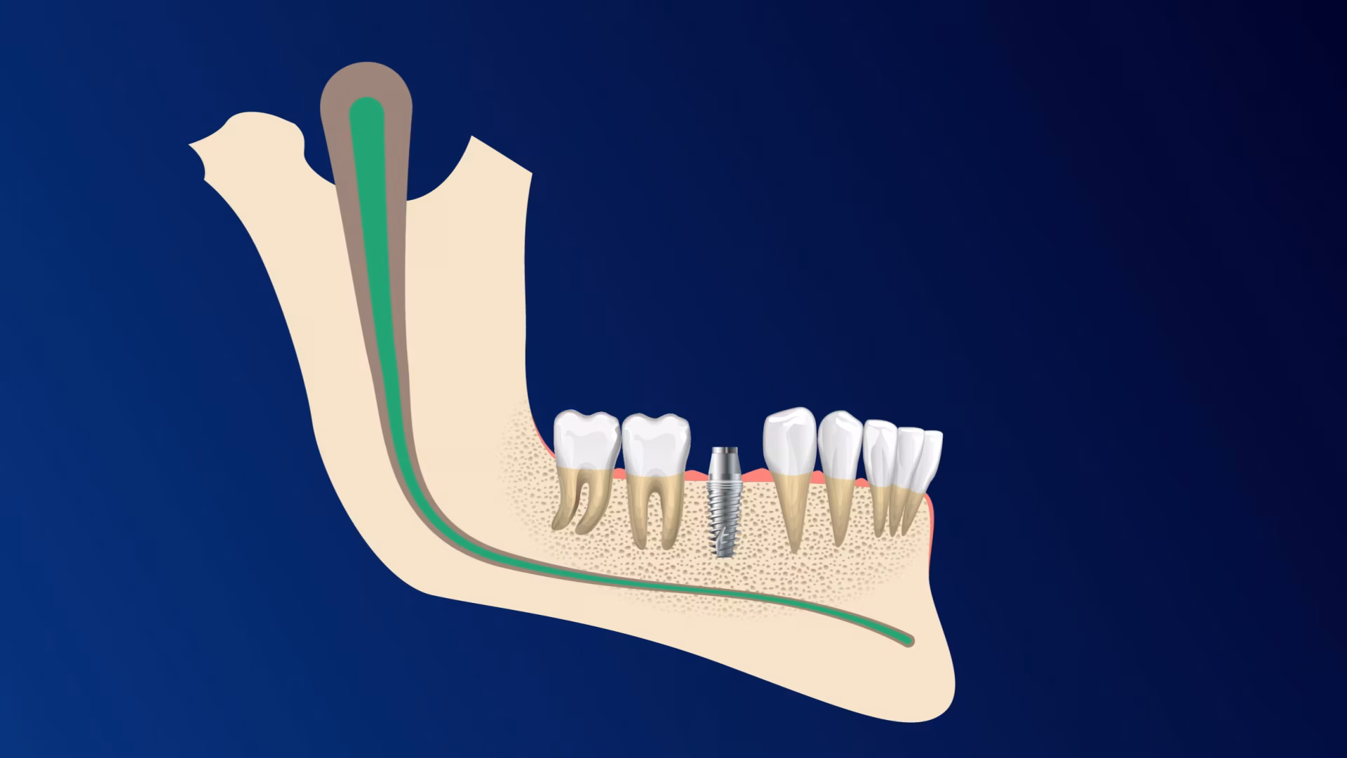 Implant Surgery Video Thumbnail